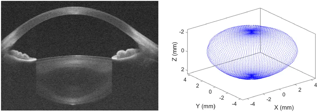 articulo-lentespropias Ala izquierda una foto de escaner del cristalino de un ojo y a la derecha una representación en 3D de la forma del cristalino calculada