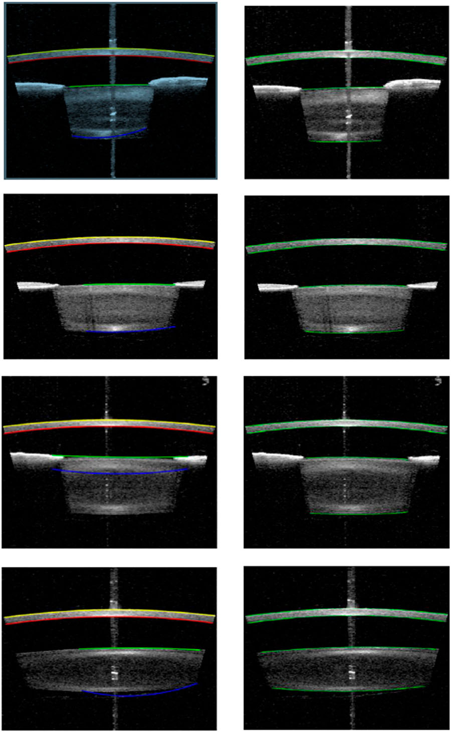 articulo-deep-learning-oct-baja 8 imágenes en las que se ve como una lámina del corte transversal de un ojo, en la que se puede distinguir las distintas capas que lo componen